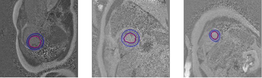 Motion Correction In Cardiac Magnetic Resonance Imaging Axel Dinh Van Chi 1745